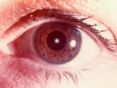 Диагноз «катаракта»