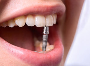 Имплантация зубов – красивая улыбка надолго