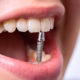 Имплантация зубов – красивая улыбка надолго
