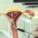 Биопсия шейки матки: достоинства радиоволнового метода
