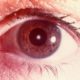 Диагноз «катаракта»